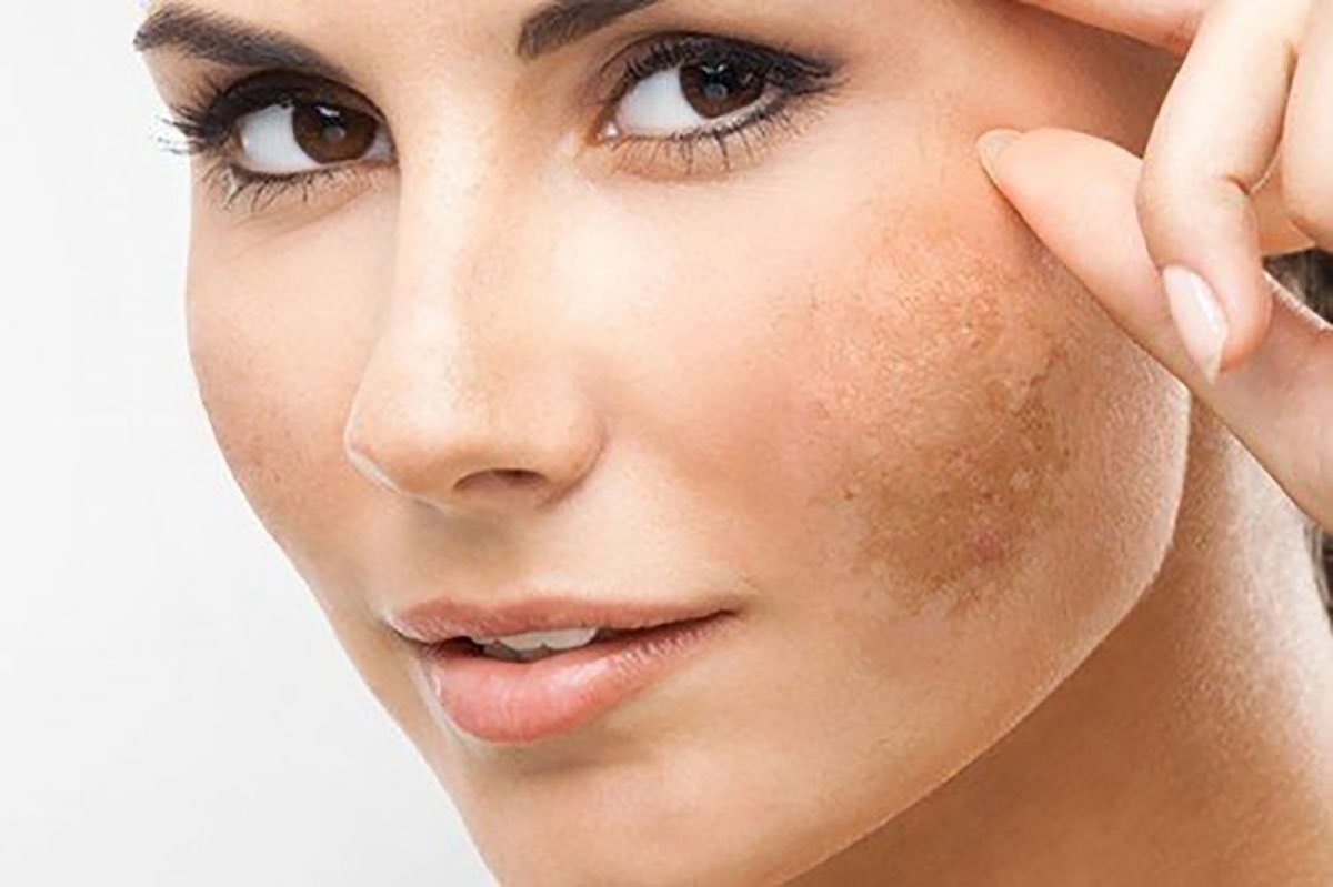 Điều trị mụn & nám
